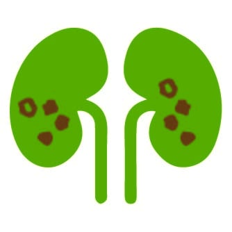 Kidney stone